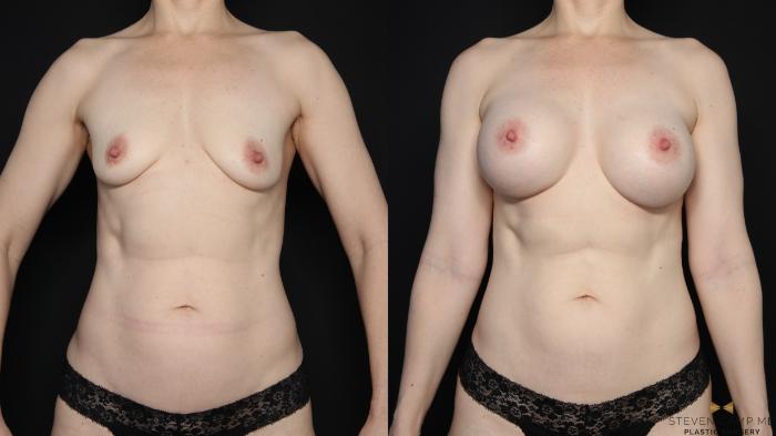 Before & After Breast Augmentation Case 668 Front View in Fort Worth & Arlington, Texas