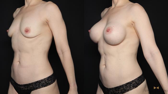 Before & After Breast Augmentation Case 668 Left Oblique View in Fort Worth & Arlington, Texas