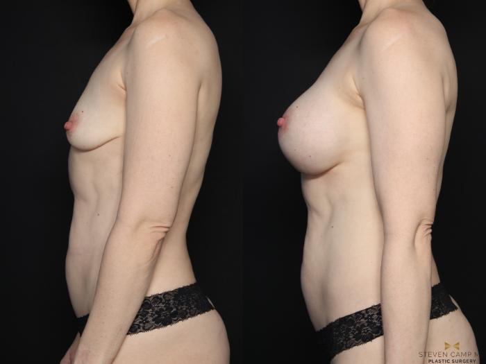 Before & After Breast Augmentation Case 668 Left Side View in Fort Worth & Arlington, Texas