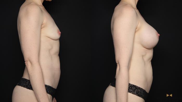 Before & After Breast Augmentation Case 668 Right Side View in Fort Worth & Arlington, Texas