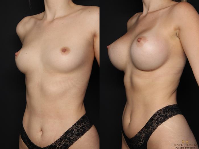 Before & After Breast Augmentation Case 669 Left Oblique View in Fort Worth & Arlington, Texas