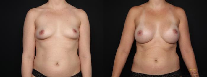 Before & After Breast Augmentation Case 676 Front View in Fort Worth & Arlington, Texas