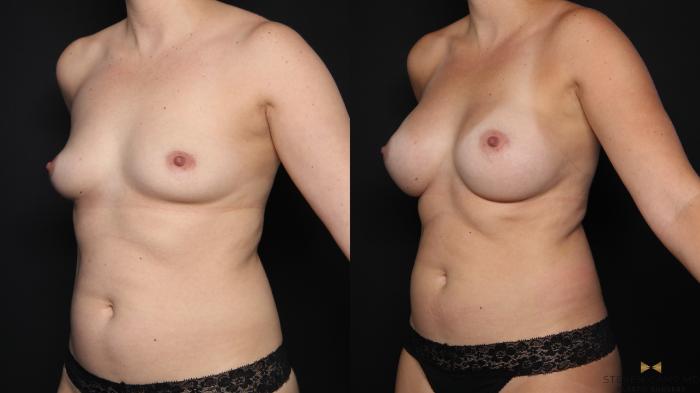 Before & After Breast Augmentation Case 676 Left Oblique View in Fort Worth & Arlington, Texas