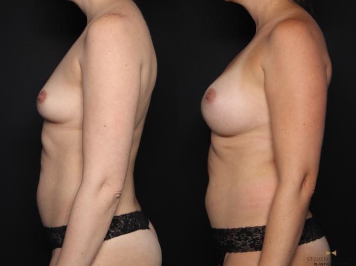 Before & After Breast Augmentation Case 676 Left Side View in Fort Worth & Arlington, Texas