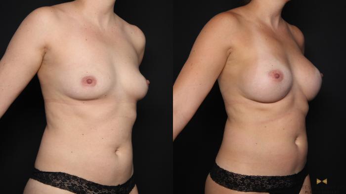 Before & After Breast Augmentation Case 676 Right Oblique View in Fort Worth & Arlington, Texas