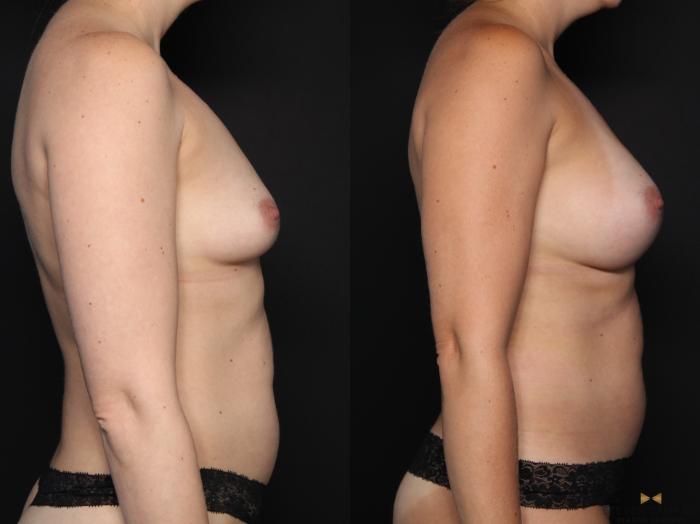 Before & After Breast Augmentation Case 676 Right Side View in Fort Worth & Arlington, Texas