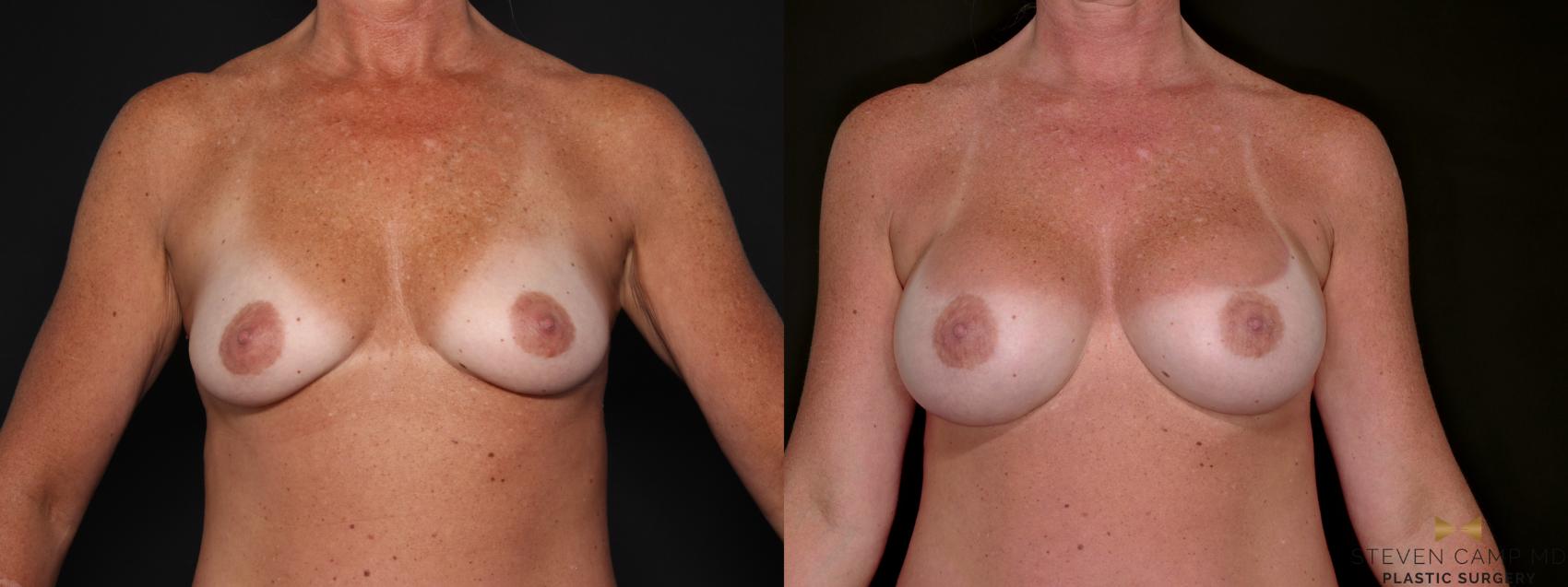 Before & After Breast Augmentation Case 688 Front View in Fort Worth & Arlington, Texas