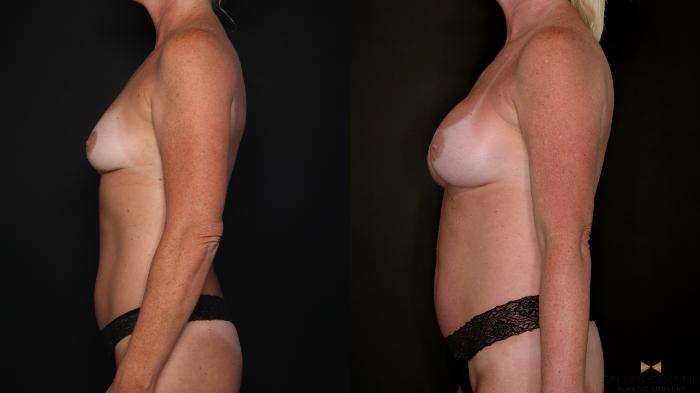 Before & After Breast Augmentation Case 688 Left Side View in Fort Worth & Arlington, Texas