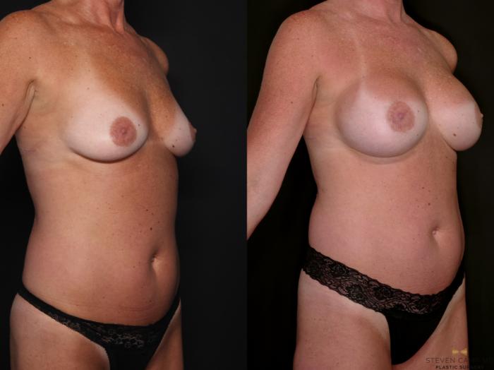 Before & After Breast Augmentation Case 688 Right Oblique View in Fort Worth & Arlington, Texas