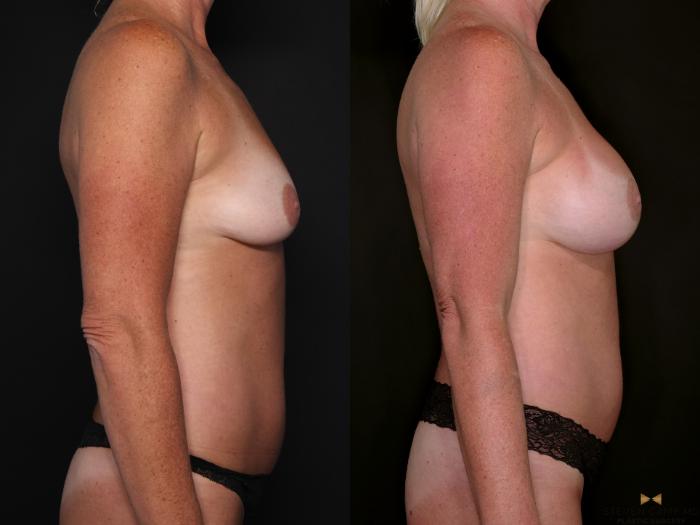 Before & After Breast Augmentation Case 688 Right Side View in Fort Worth & Arlington, Texas