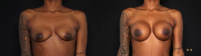 Before & After Breast Augmentation Case 693 Front View in Fort Worth & Arlington, Texas