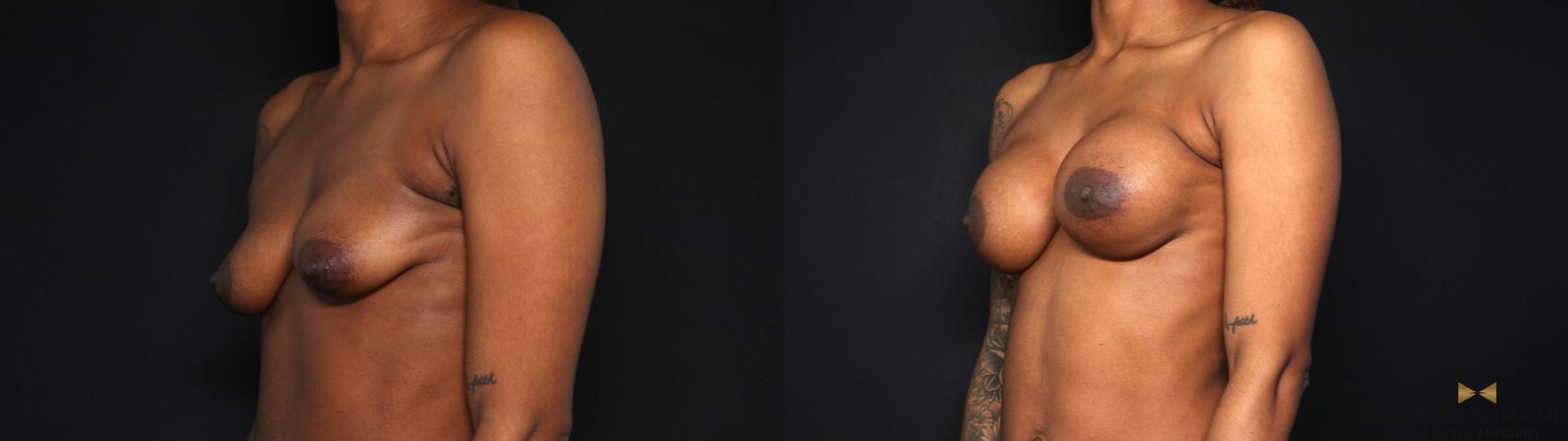 Before & After Breast Augmentation Case 693 Left Oblique View in Fort Worth & Arlington, Texas