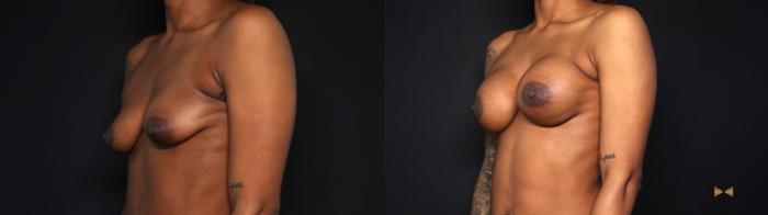 Before & After Breast Augmentation Case 693 Left Oblique View in Fort Worth & Arlington, Texas