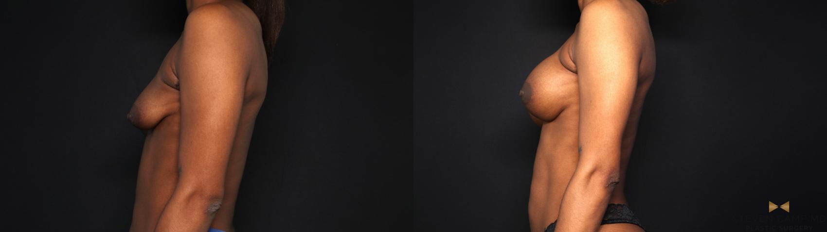 Before & After Breast Augmentation Case 693 Left Side View in Fort Worth & Arlington, Texas