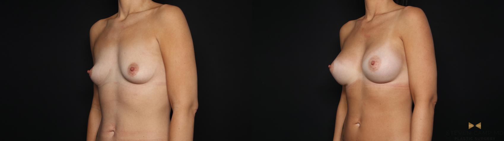 Before & After Breast Augmentation Case 694 Left Oblique View in Fort Worth & Arlington, Texas