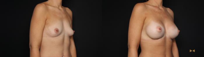 Before & After Breast Augmentation Case 694 Right Oblique View in Fort Worth & Arlington, Texas