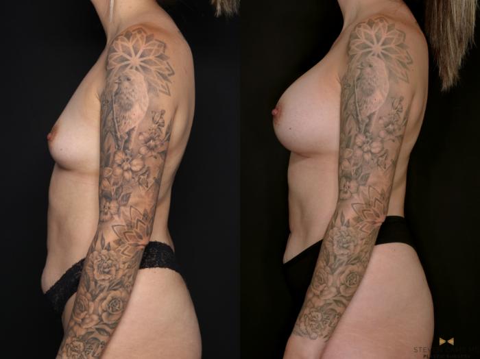 Before & After Breast Augmentation Case 697 Left Side View in Fort Worth & Arlington, Texas