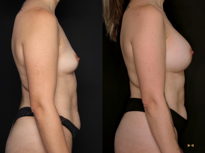 Before & After Breast Augmentation Case 697 Right Side View in Fort Worth & Arlington, Texas