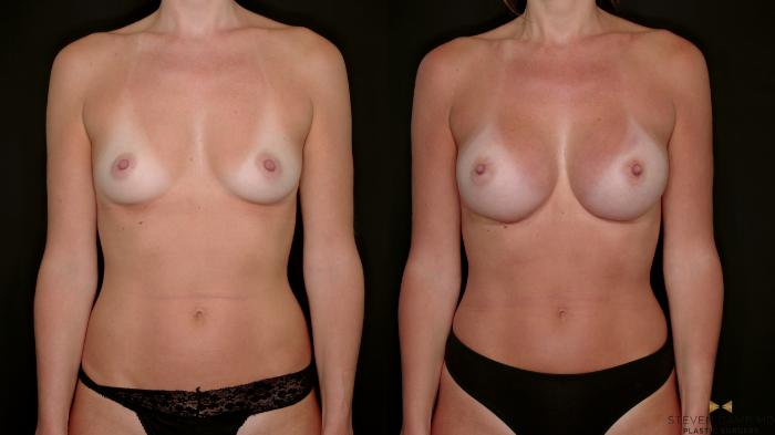 Before & After Breast Augmentation Case 698 Front View in Fort Worth & Arlington, Texas