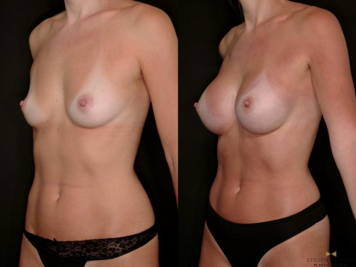 Before & After Breast Augmentation Case 698 Left Oblique View in Fort Worth & Arlington, Texas