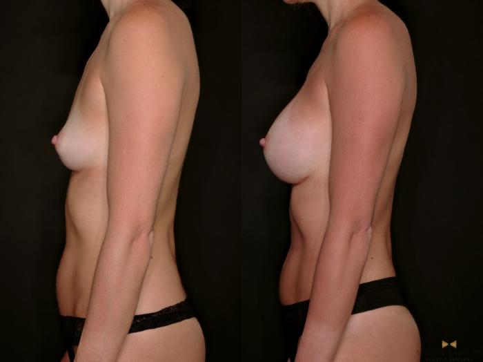 Before & After Breast Augmentation Case 698 Left Side View in Fort Worth & Arlington, Texas