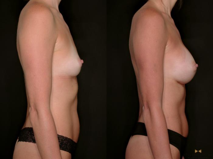 Before & After Breast Augmentation Case 698 Right Side View in Fort Worth & Arlington, Texas