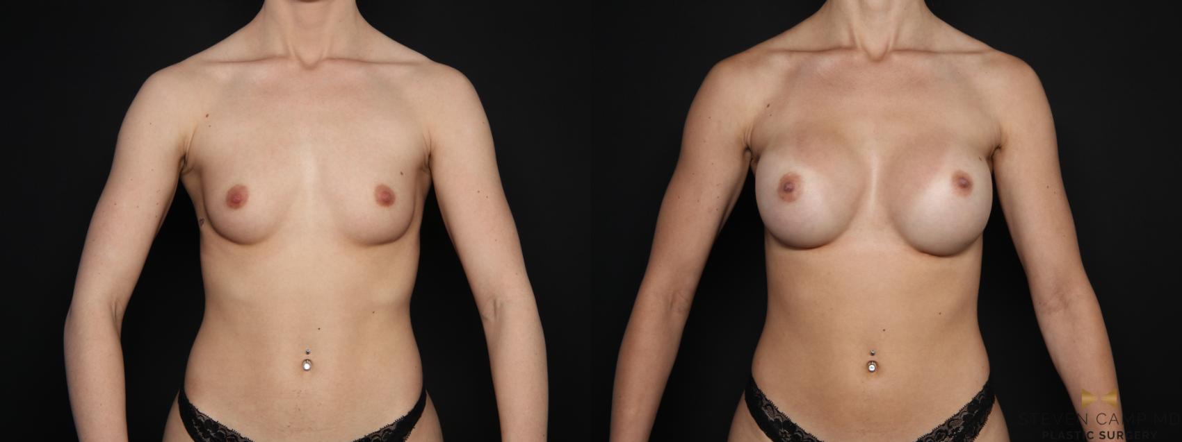 Before & After Breast Augmentation Case 708 Front View in Fort Worth & Arlington, Texas