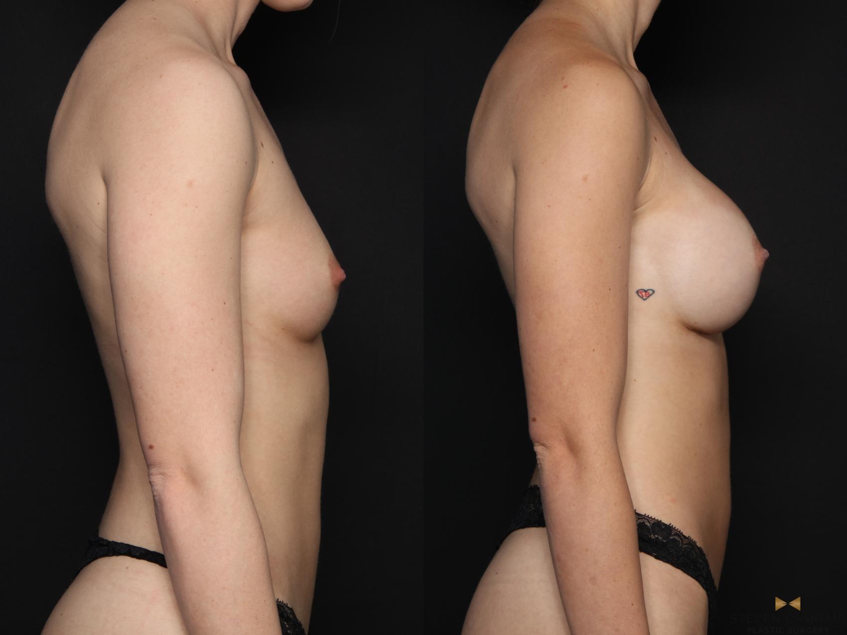 Before & After Breast Augmentation Case 708 Right Side View in Fort Worth & Arlington, Texas