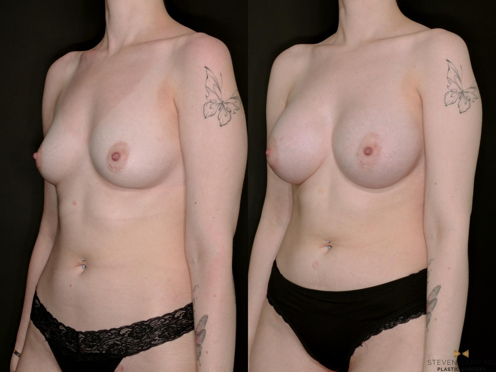 Before & After Breast Augmentation Case 733 Left Oblique View in Fort Worth & Arlington, Texas