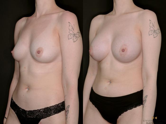 Before & After Breast Augmentation Case 733 Left Oblique View in Fort Worth & Arlington, Texas
