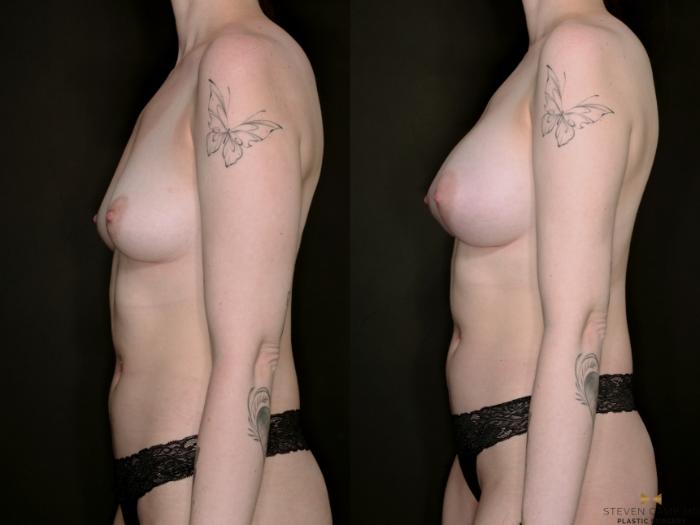 Before & After Breast Augmentation Case 733 Left Side View in Fort Worth & Arlington, Texas