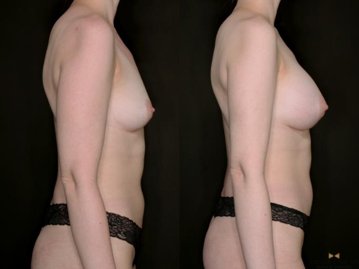 Before & After Breast Augmentation Case 733 Right Side View in Fort Worth & Arlington, Texas