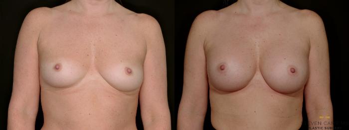 Before & After Internal Bra (Galaflex) Case 734 Front View in Fort Worth & Arlington, Texas