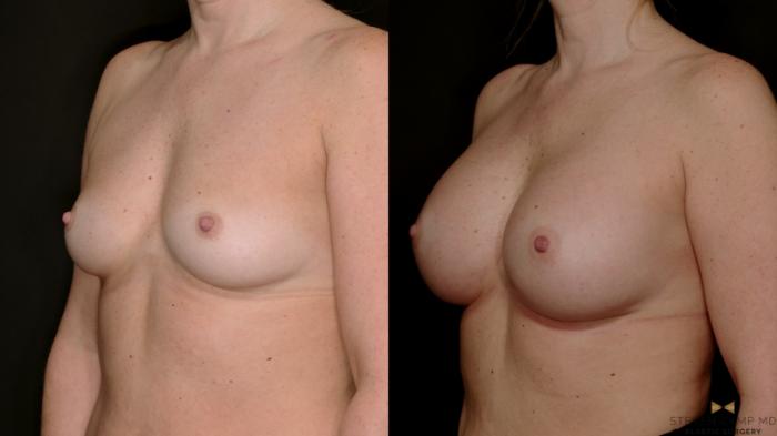 Before & After Internal Bra (Galaflex) Case 734 Left Oblique View in Fort Worth & Arlington, Texas