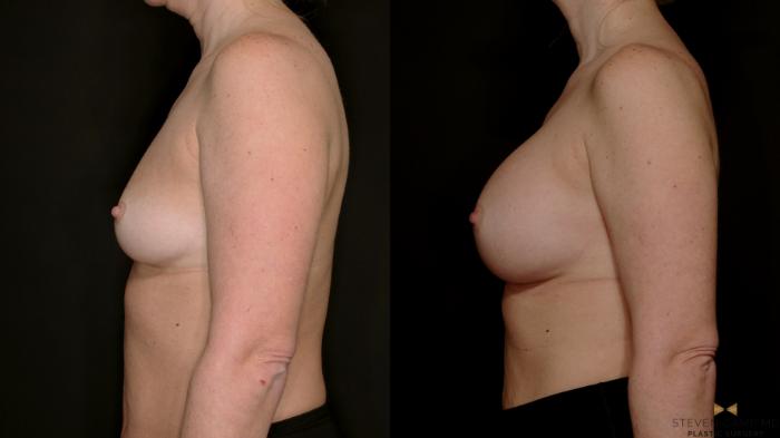 Before & After Internal Bra (Galaflex) Case 734 Left Side View in Fort Worth & Arlington, Texas