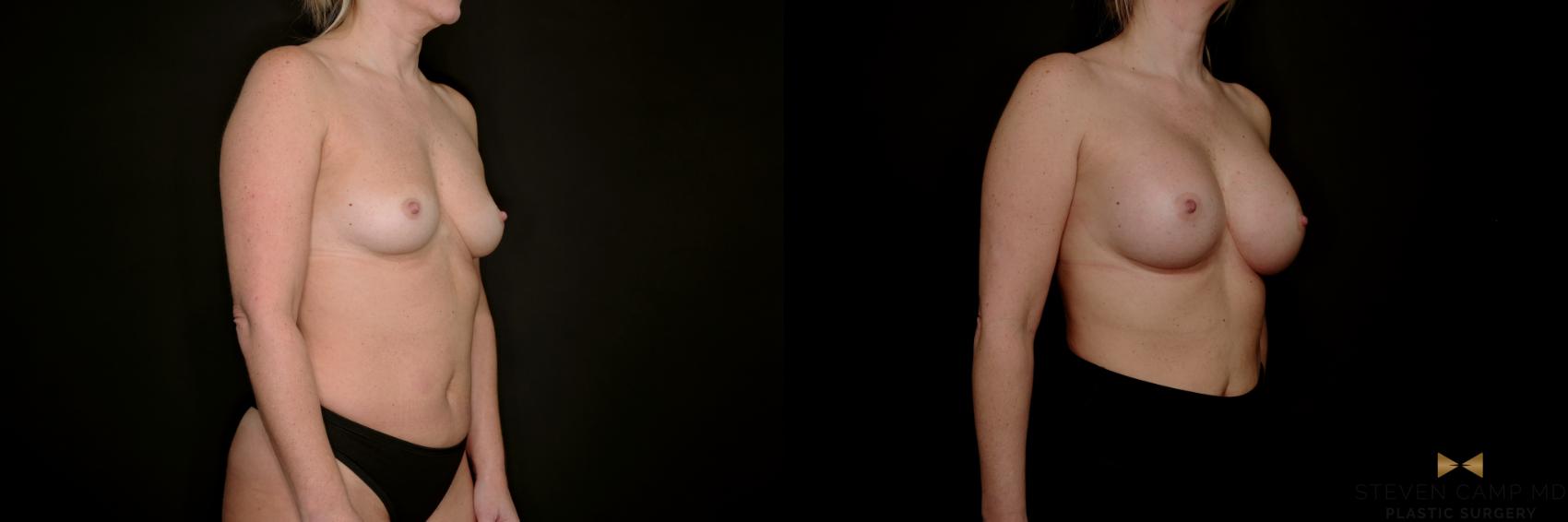 Before & After Breast Augmentation Case 734 Right Oblique View in Fort Worth & Arlington, Texas