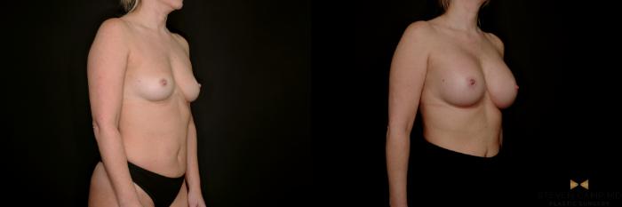 Before & After Internal Bra (Galaflex) Case 734 Right Oblique View in Fort Worth & Arlington, Texas
