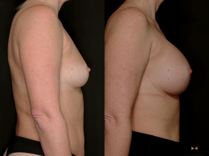 Before & After Internal Bra (Galaflex) Case 734 Right Side View in Fort Worth & Arlington, Texas