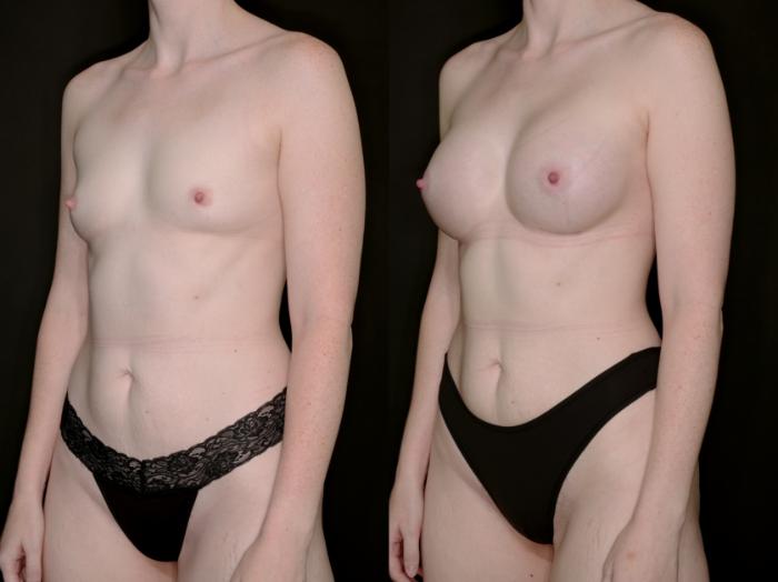 Before & After Breast Augmentation Case 735 Left Oblique View in Fort Worth & Arlington, Texas