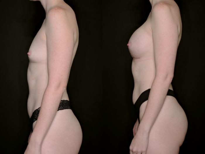 Before & After Breast Augmentation Case 735 Left Side View in Fort Worth & Arlington, Texas