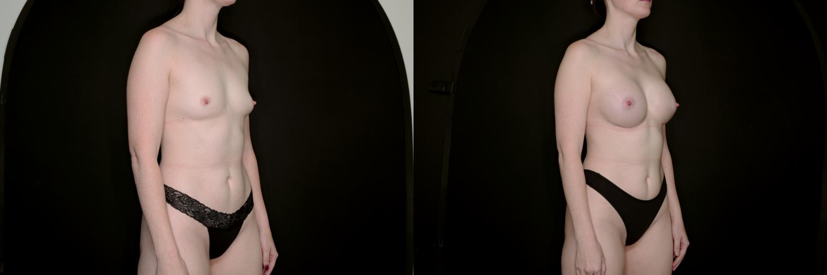 Before & After Breast Augmentation Case 735 Right Oblique View in Fort Worth & Arlington, Texas