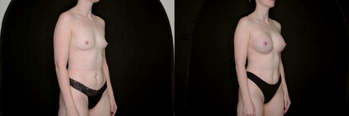 Before & After Breast Augmentation Case 735 Right Oblique View in Fort Worth & Arlington, Texas