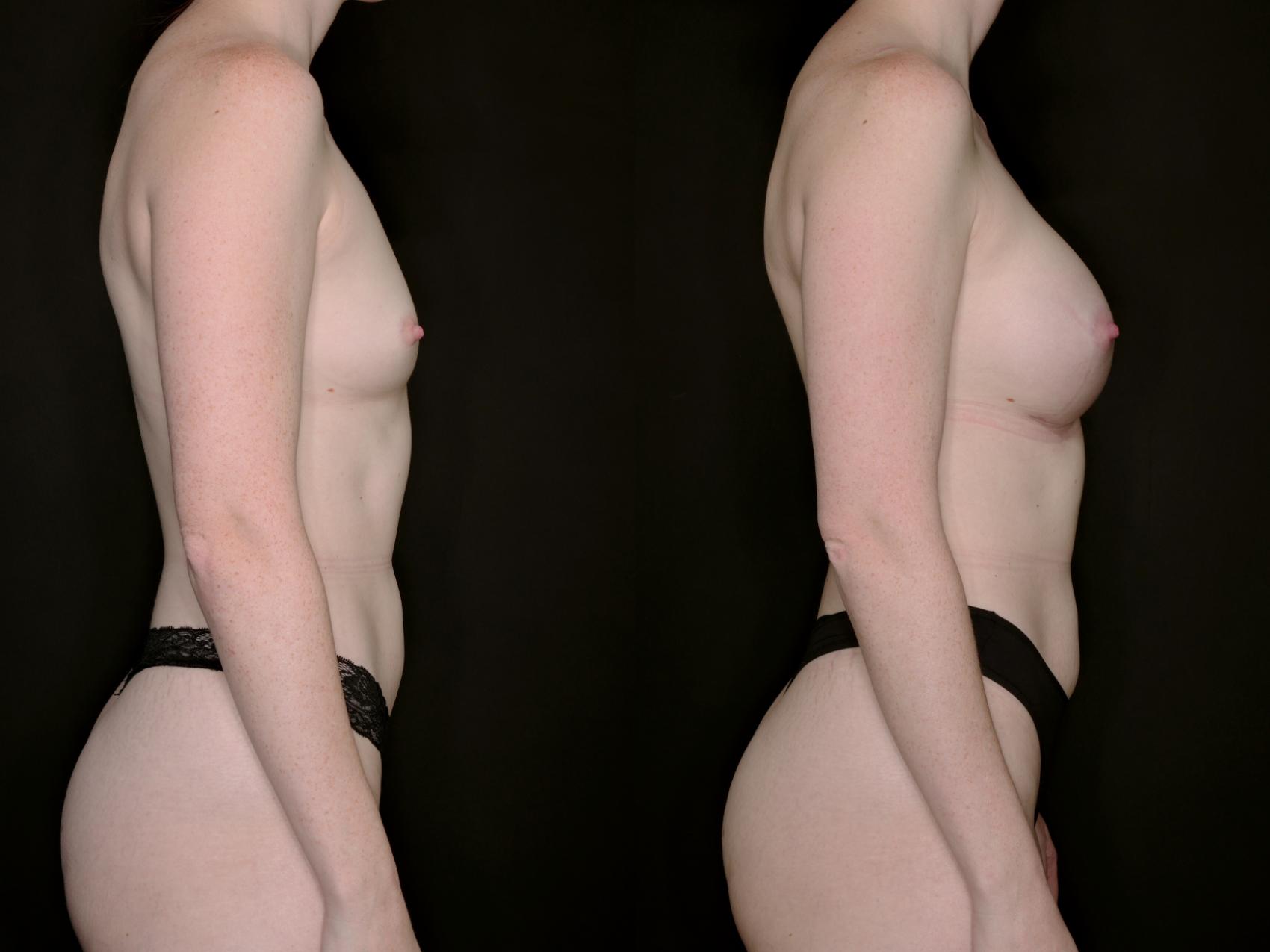 Before & After Breast Augmentation Case 735 Right Side View in Fort Worth & Arlington, Texas