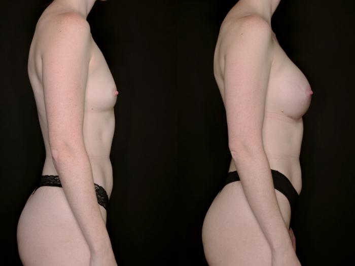 Before & After Breast Augmentation Case 735 Right Side View in Fort Worth & Arlington, Texas