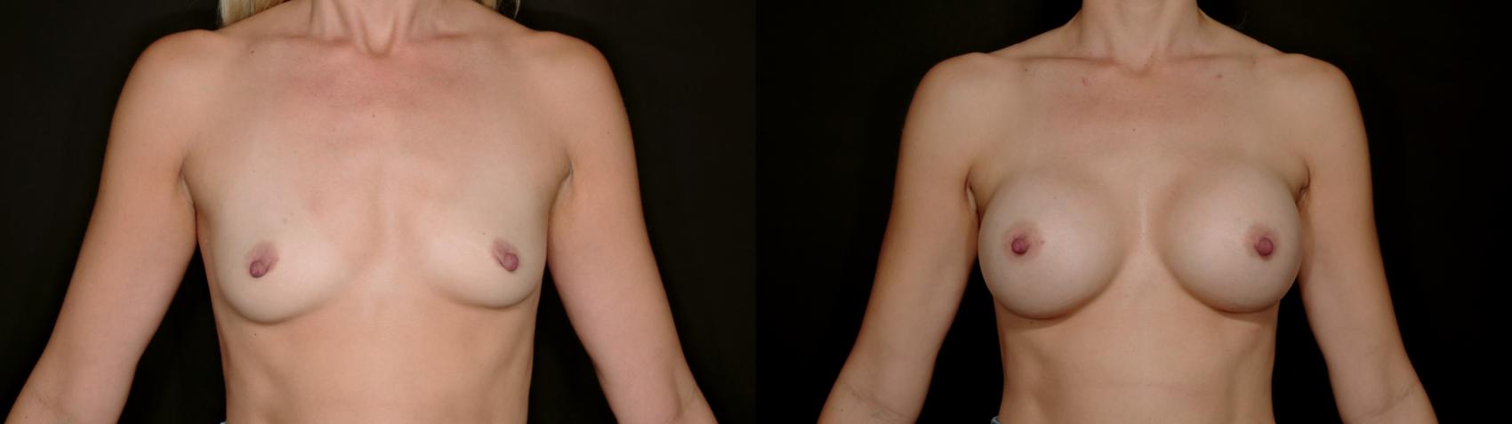 Before & After Breast Augmentation Case 754 Frontal Arms Up  View in Fort Worth & Arlington, Texas