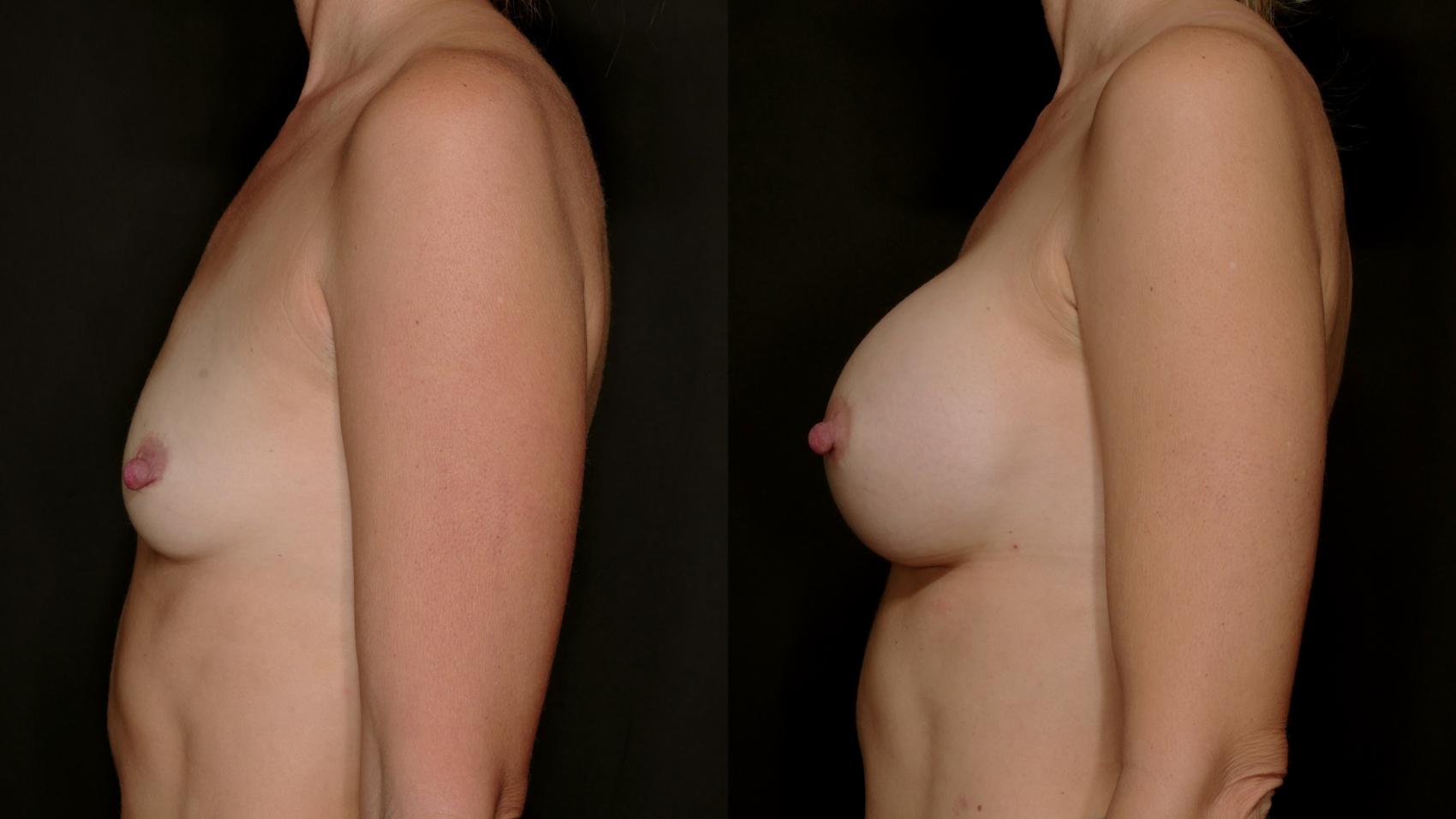 Before & After Breast Augmentation Case 754 Left Side View in Fort Worth & Arlington, Texas