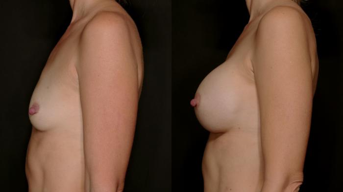 Before & After Breast Augmentation Case 754 Left Side View in Fort Worth & Arlington, Texas
