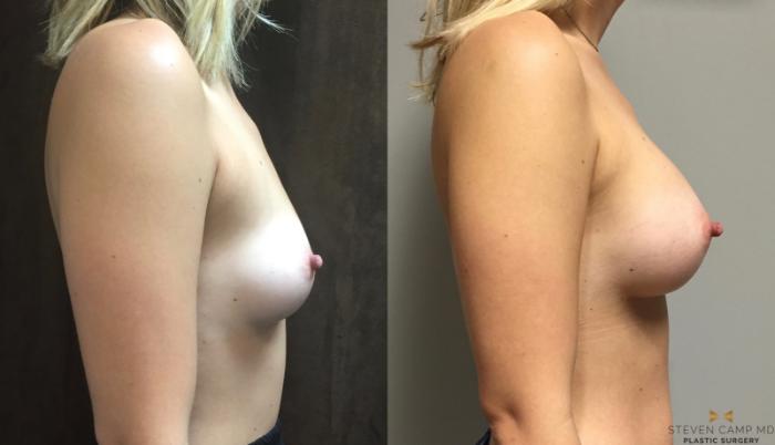 Before & After Breast Augmentation Case 76 View #3 View in Fort Worth, Texas