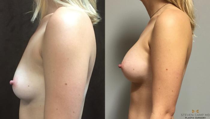 Before & After Breast Augmentation Case 76 View #5 View in Fort Worth, Texas
