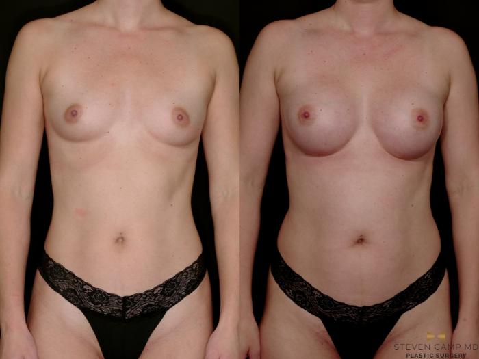 Before & After Breast Augmentation Case 765 Front View in Fort Worth & Arlington, Texas